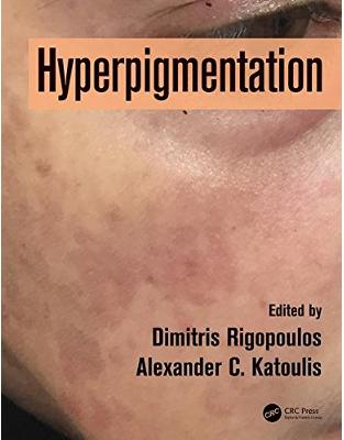 Hyperpigmentation Hyperpigmentation