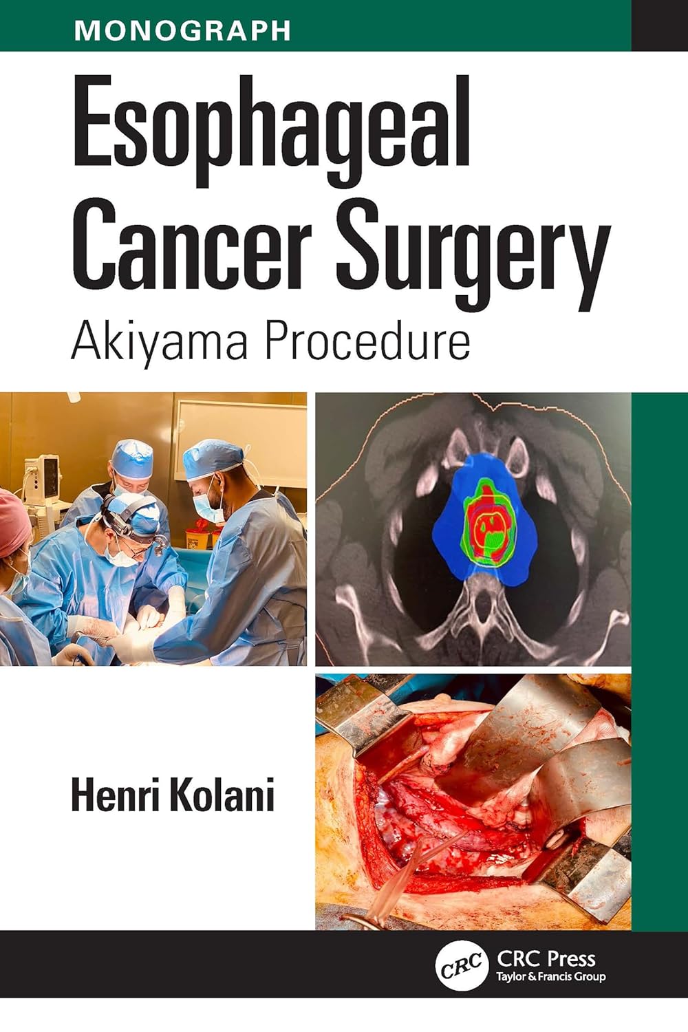 Coperta cărții "Esophageal Cancer Surgery: Akiyama Procedure" de autor necunoscut
