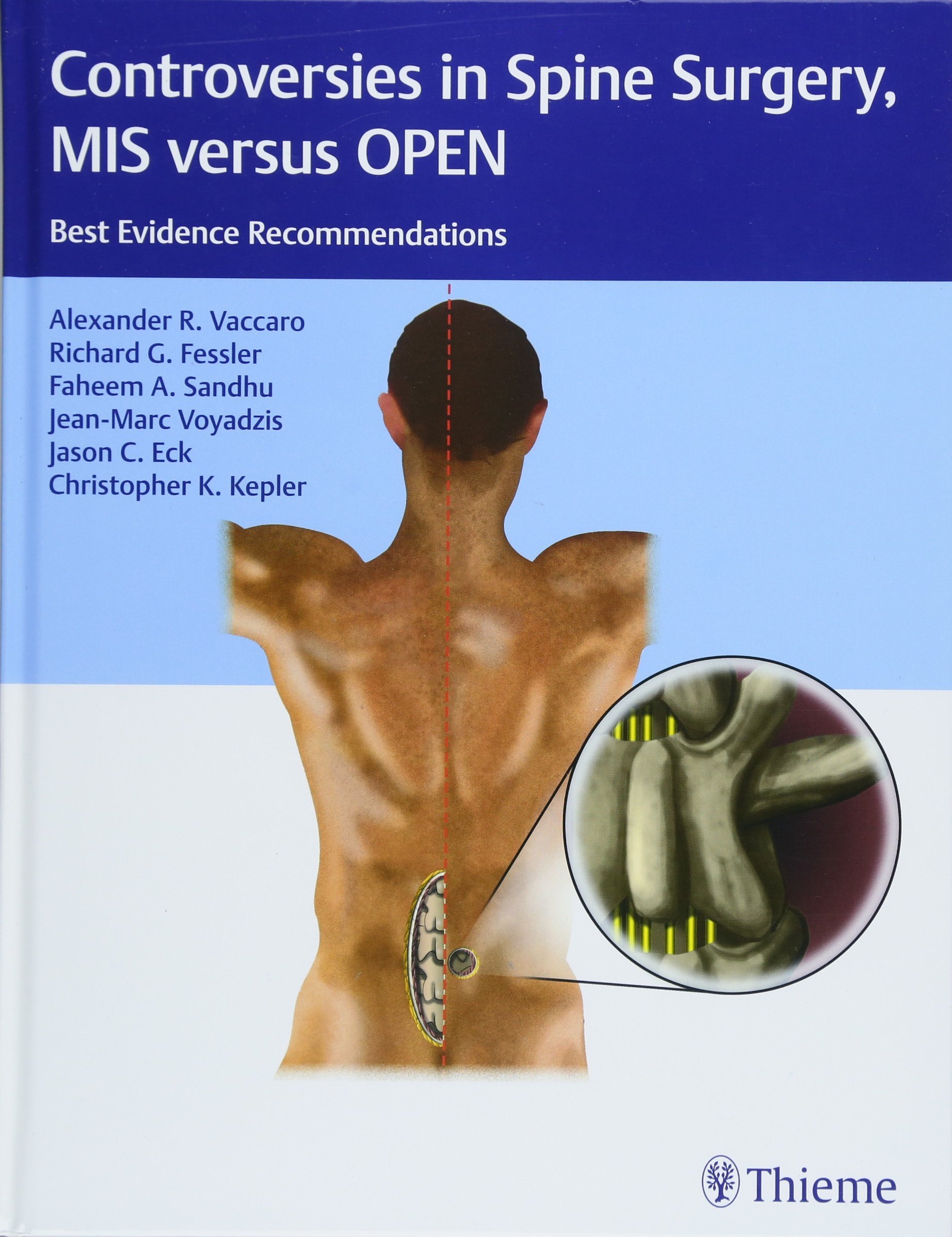 Coperta cărții "Controversies in Spine Surgery, MIS versus OPEN: Best Evidence Recommendations" de autor necunoscut
