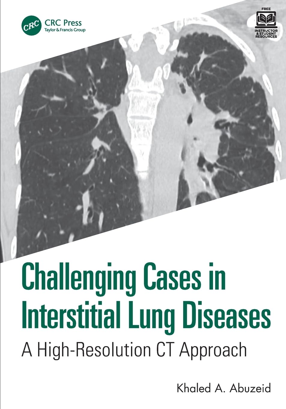 Coperta cărții "Challenging Cases in Interstitial Lung Diseases: A High-Resolution CT Approach" de autor necunoscut
