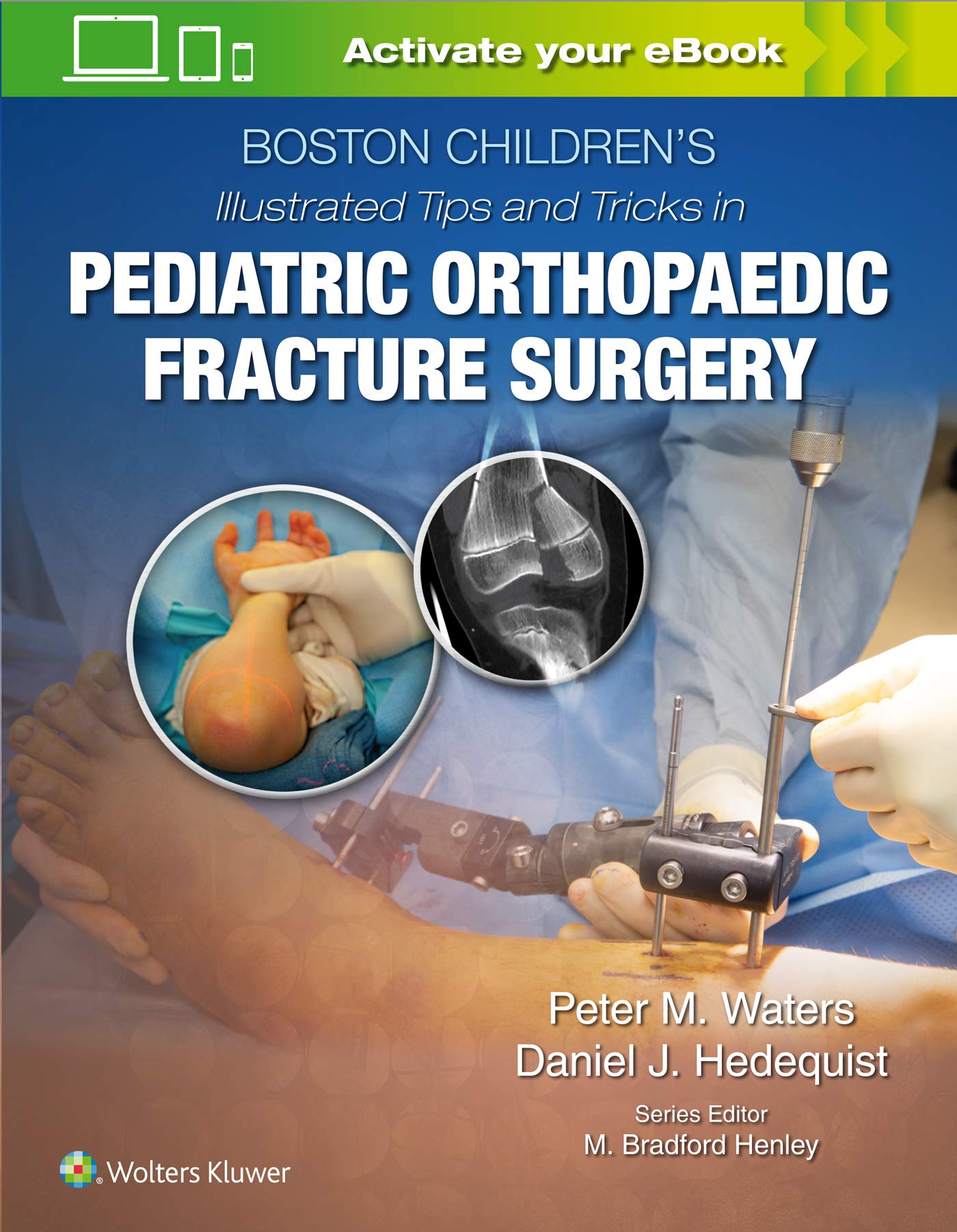 Coperta cărții "Boston Children&amp;#146;s Illustrated Tips and Tricks in Pediatric Orthopaedic Fracture Surgery" de autor necunoscut