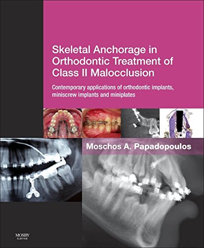 Coperta cărții "Skeletal Anchorage in Orthodontic Treatment of Class II Malocclusion" de autor necunoscut