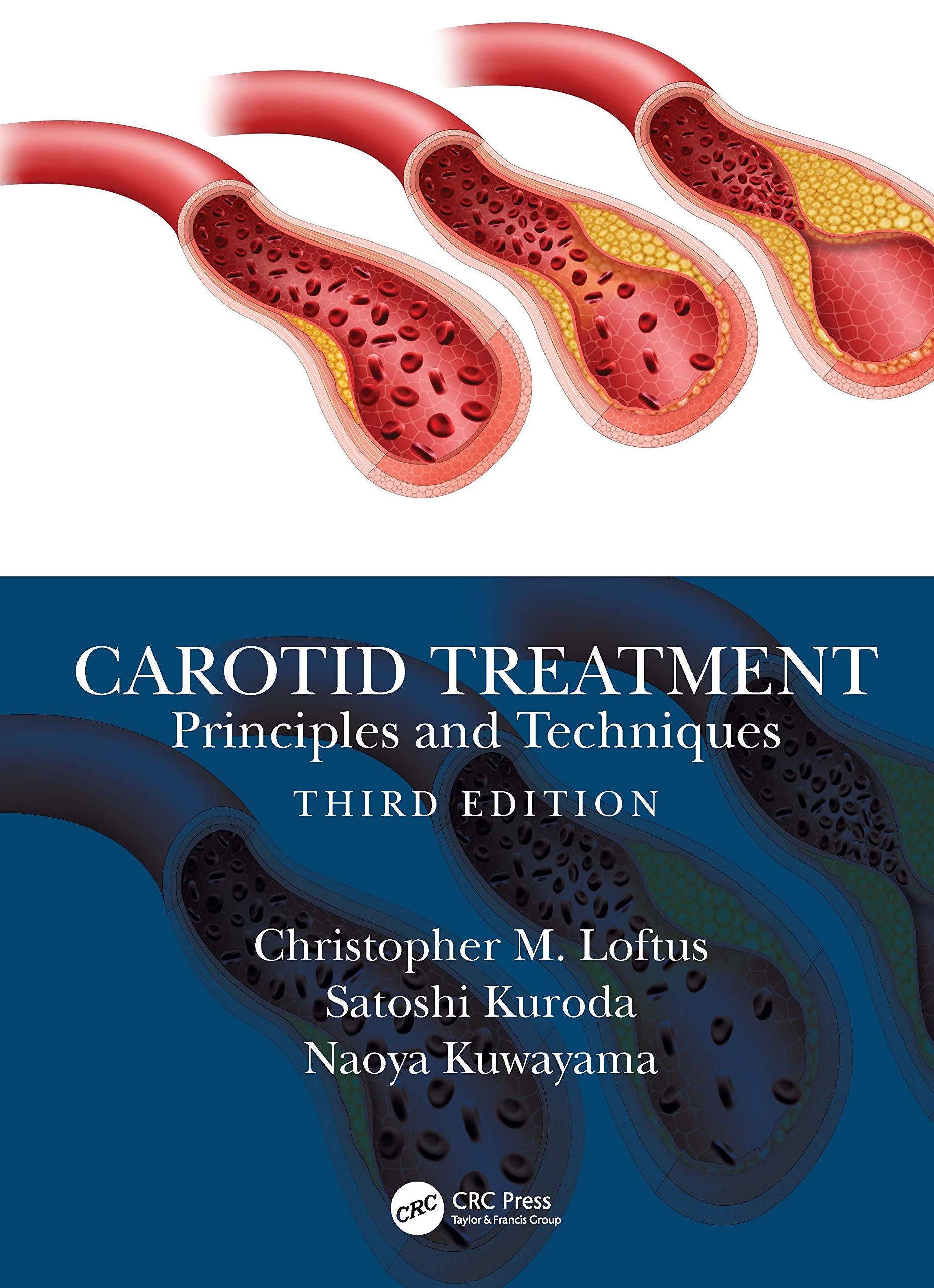 Coperta cărții "Carotid Treatment: Principles and Techniques" de autor necunoscut