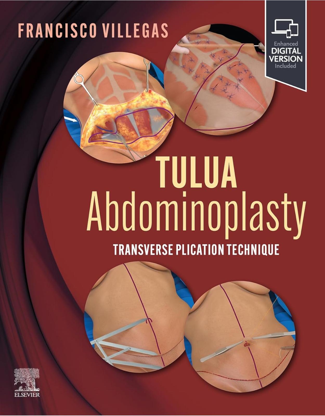 TULUA Abdominoplasty: Transverse Plication Technique