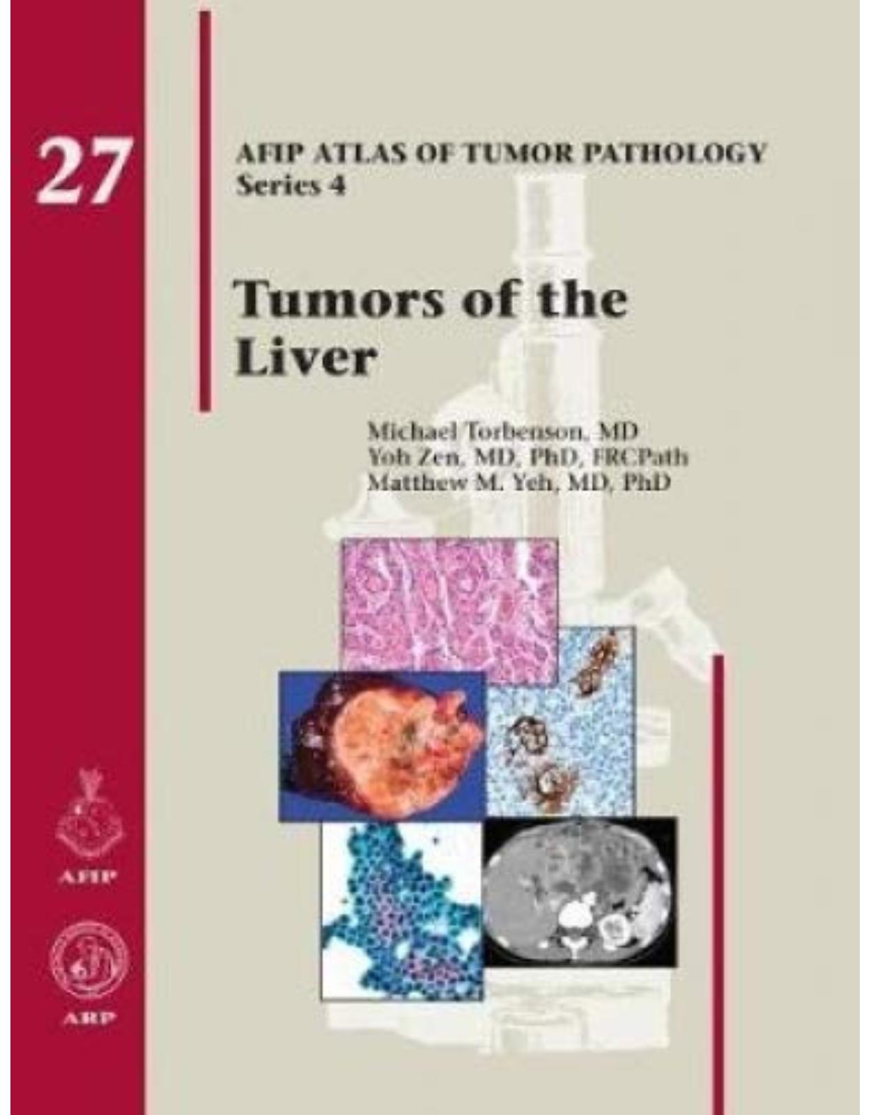Tumors of the Liver 