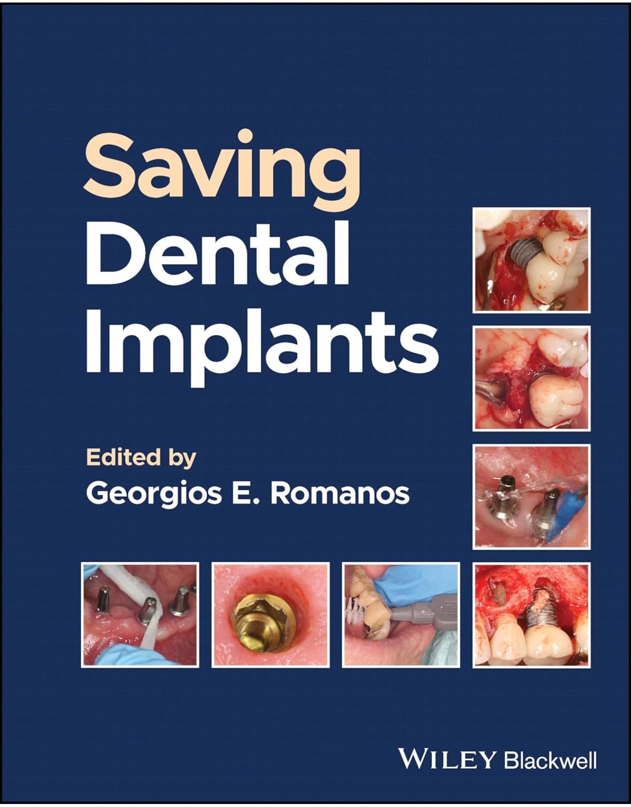 Saving Dental Implants