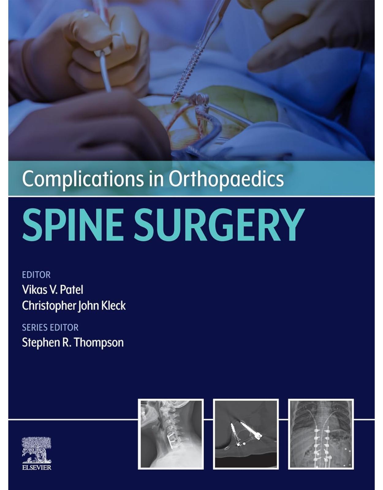 Complications in Orthopaedics: Spine Surgery