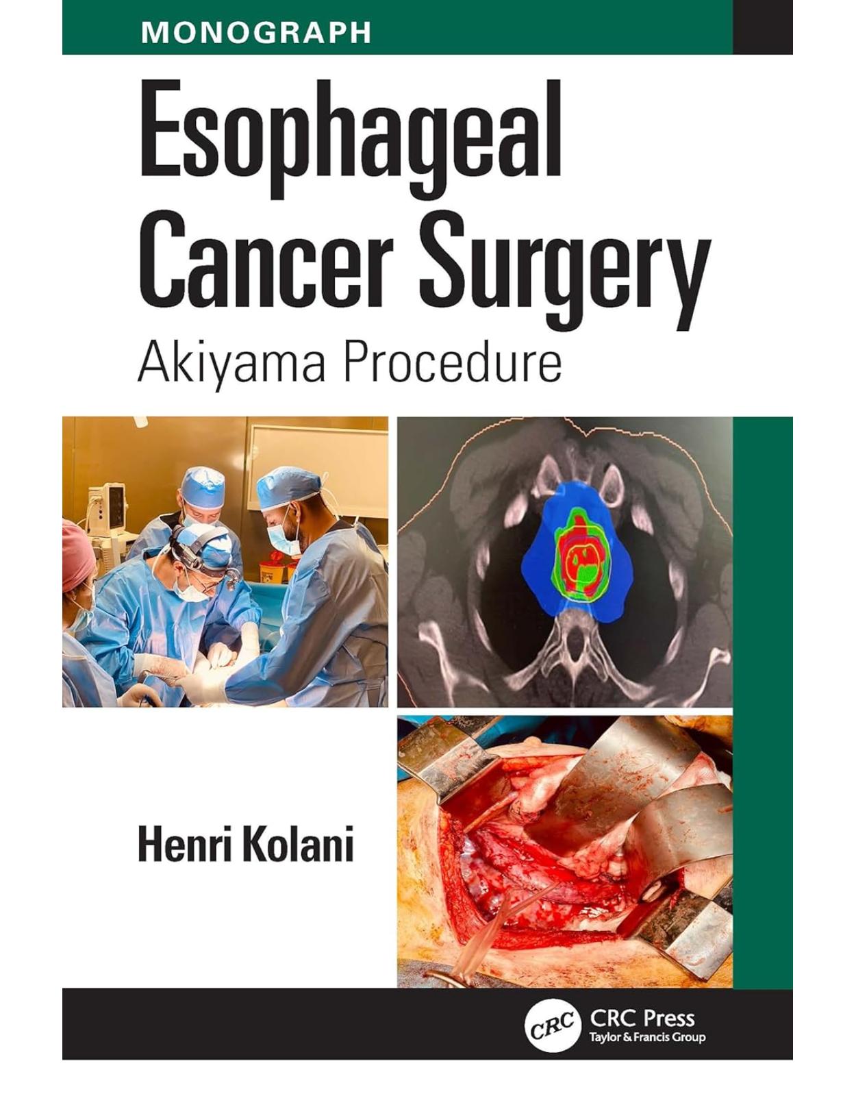 Esophageal Cancer Surgery: Akiyama Procedure