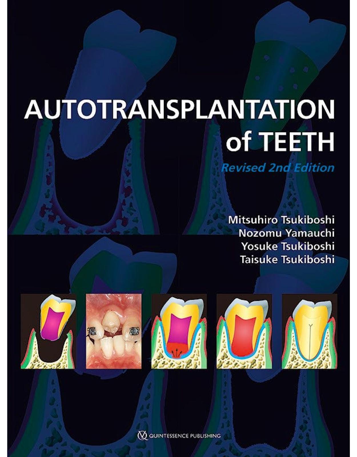 Autotransplantation of Teeth