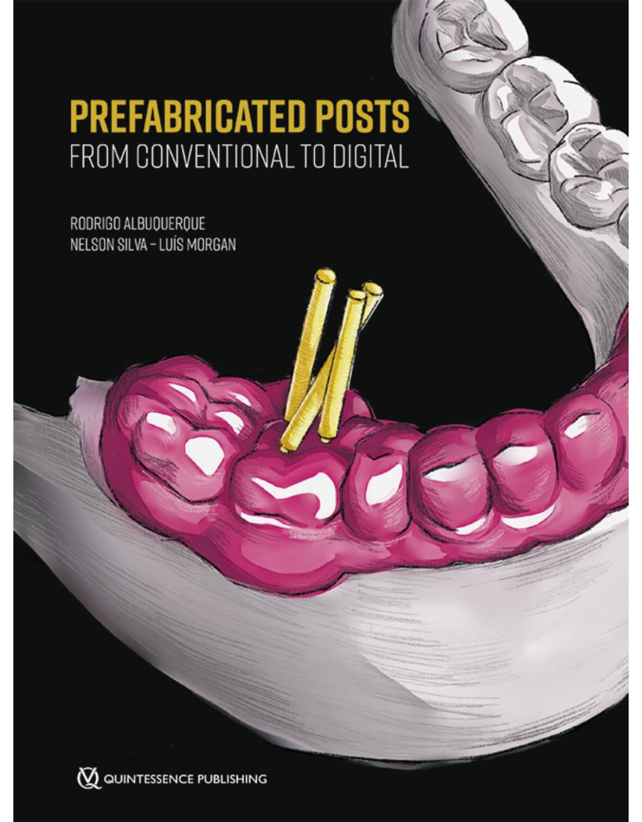 Prefabricated Posts: From Conventional to Digital