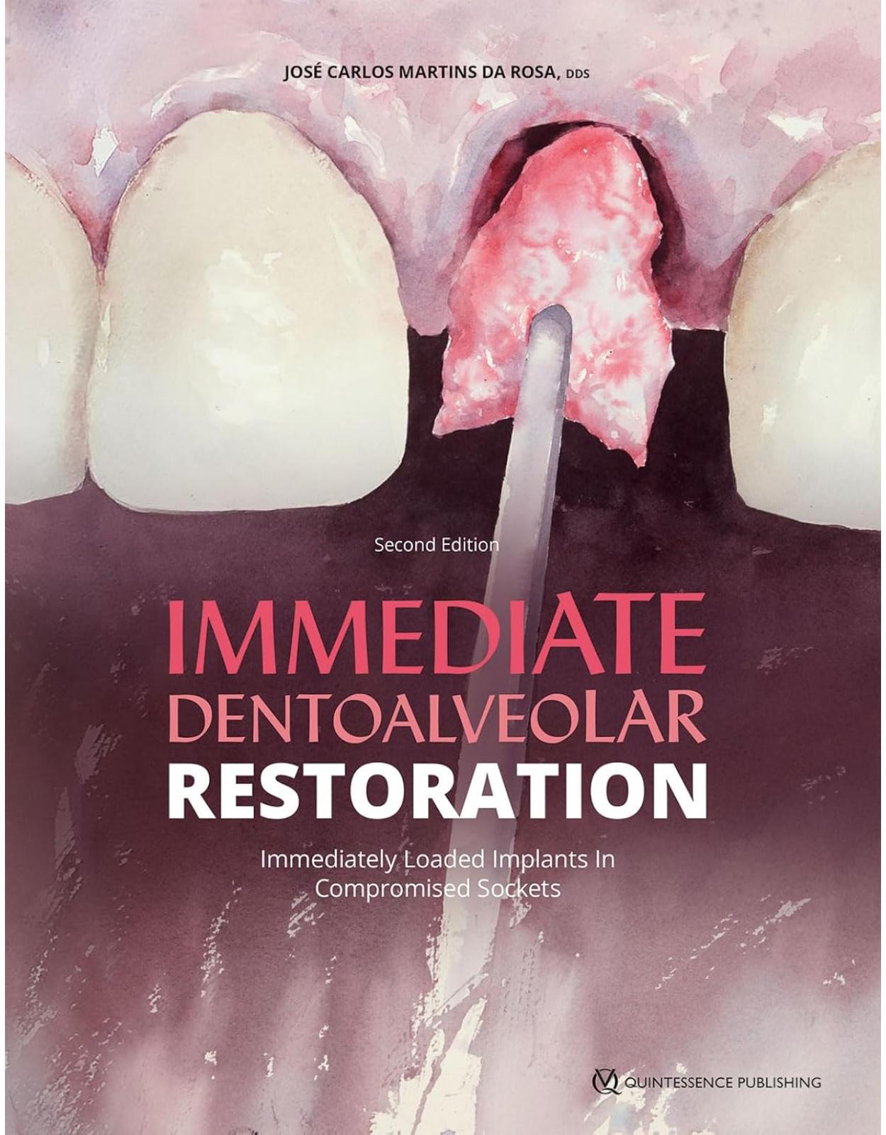 Immediate Dentoalveolar Restoration: Immediately Loaded Implants in Compromised Sockets 