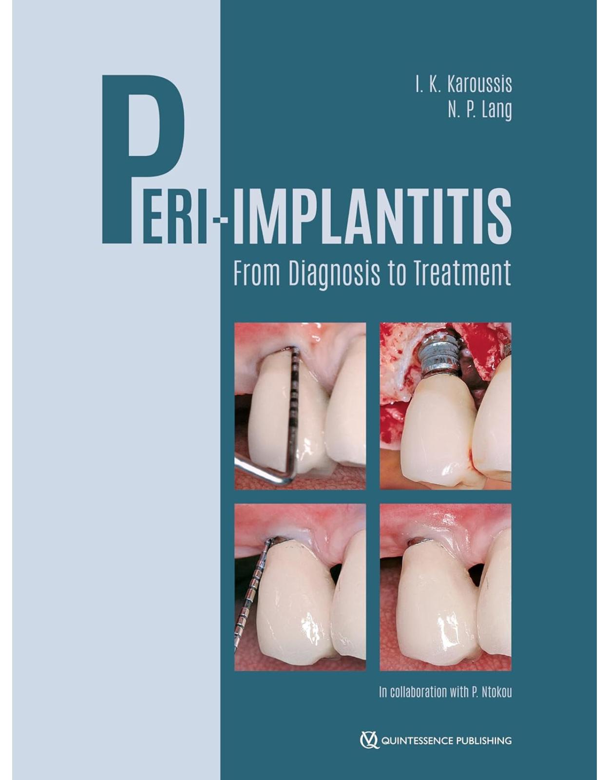 Peri-Implantitis: From Diagnosis to Treatment 