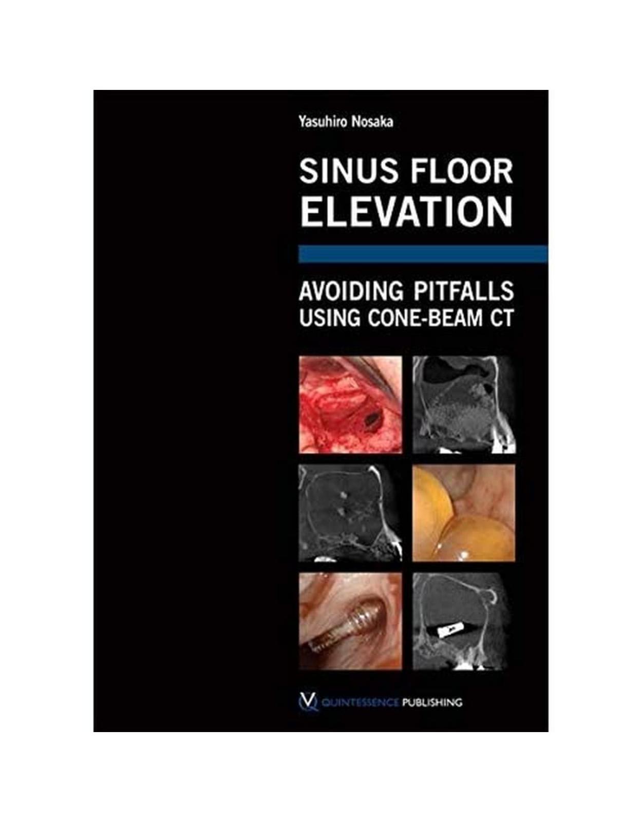 Sinus Floor Elevation: Avoiding Pitfalls Using Cone-Beam CT