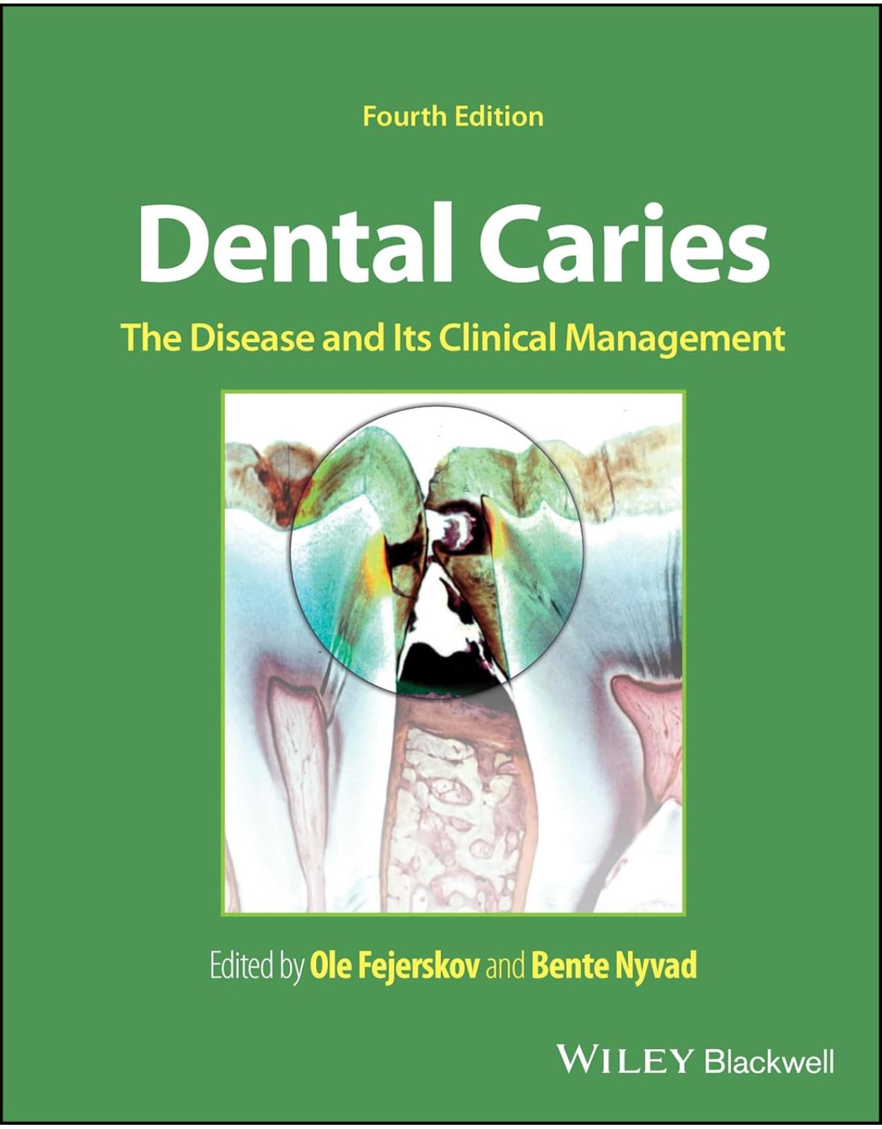 Dental Caries: The Disease and its Clinical Management 