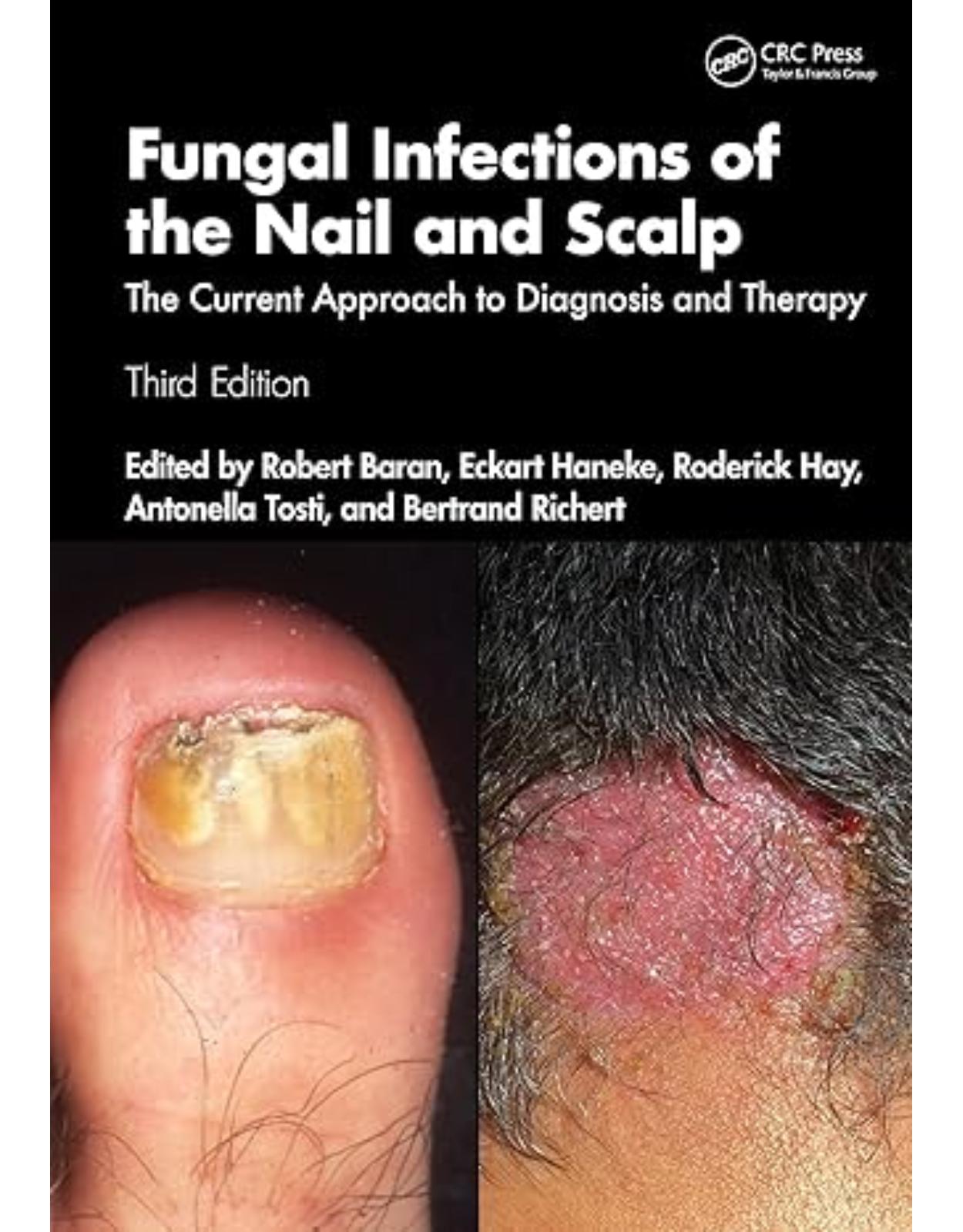 Fungal Infections of the Nail and Scalp: The Current Approach to Diagnosis and Therapy