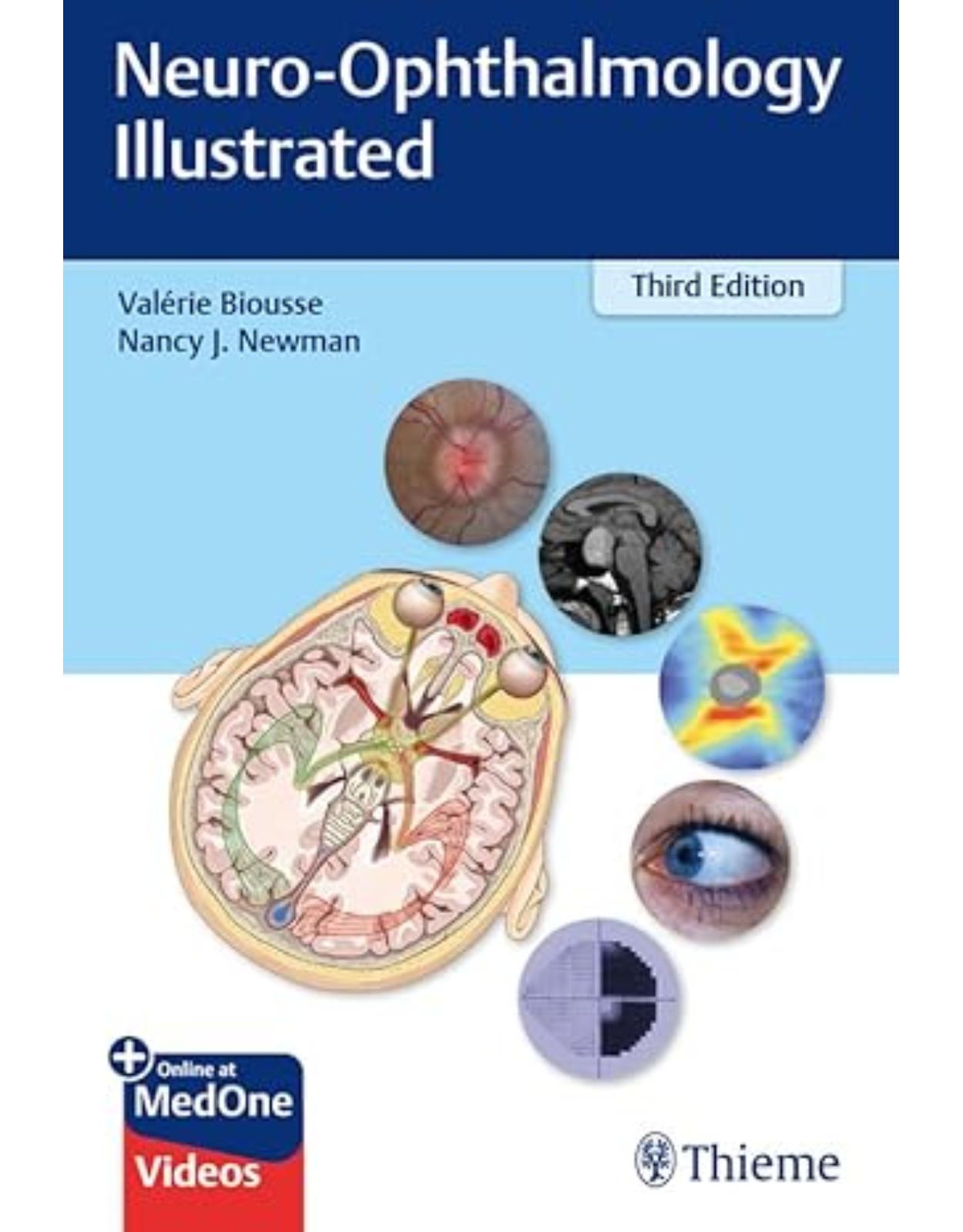 Neuro–Ophthalmology Illustrated