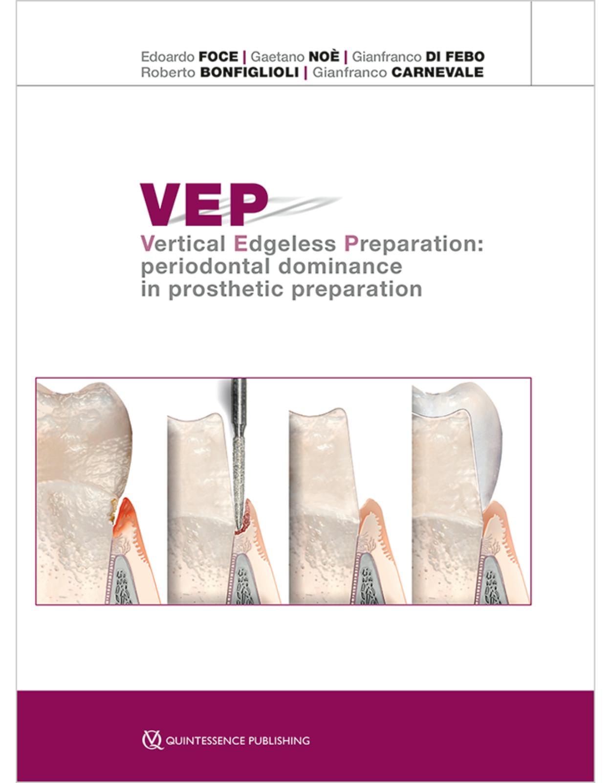 VEP Vertical Edgeless Preparation