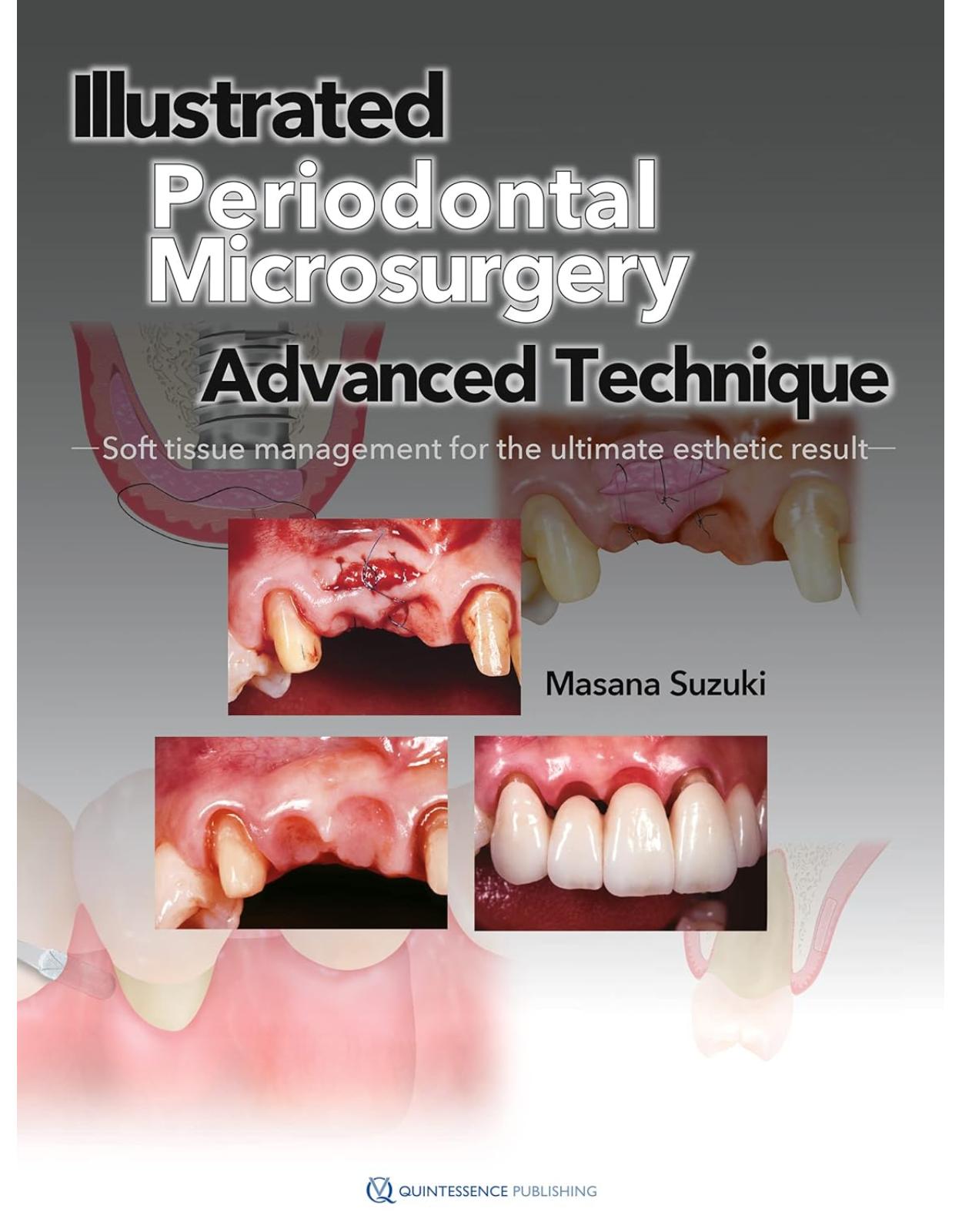 Illustrated Advanced Technique of Periodontal Microsurgery