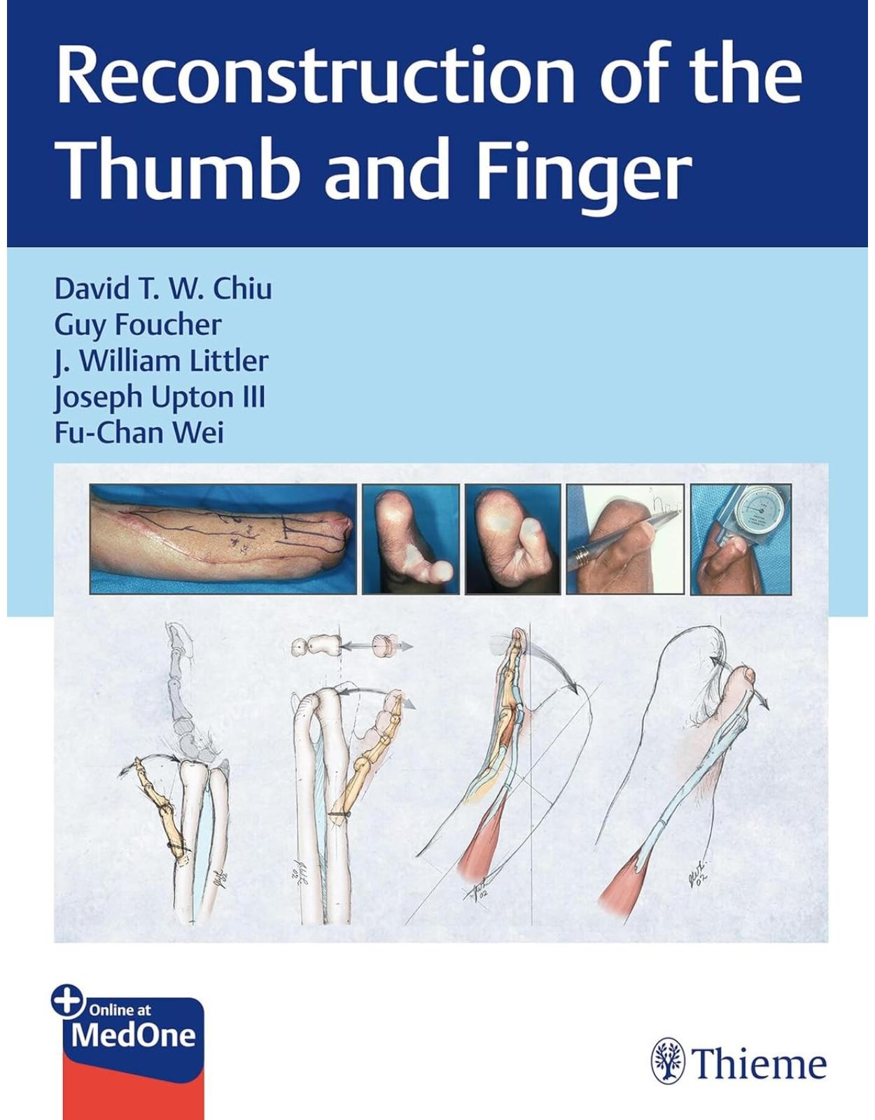 Reconstruction of the Thumb and Finger