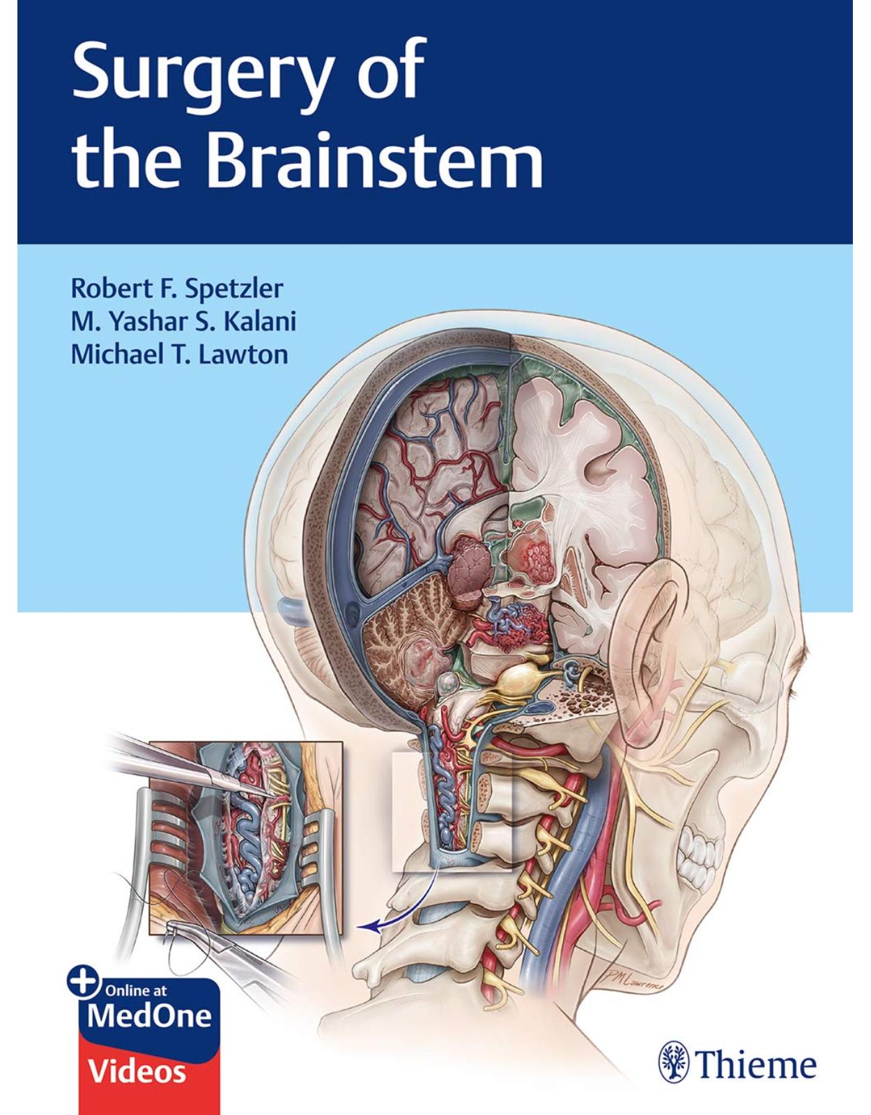 Surgery of the Brainstem