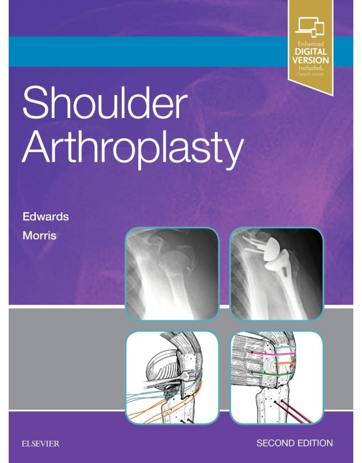 Shoulder Arthroplasty, 2e 