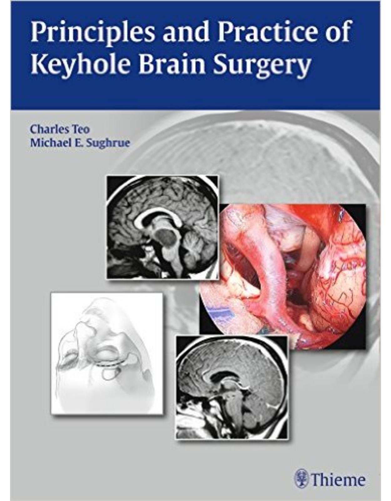 Principles and Practice of Keyhole Brain Surgery 1st edition 