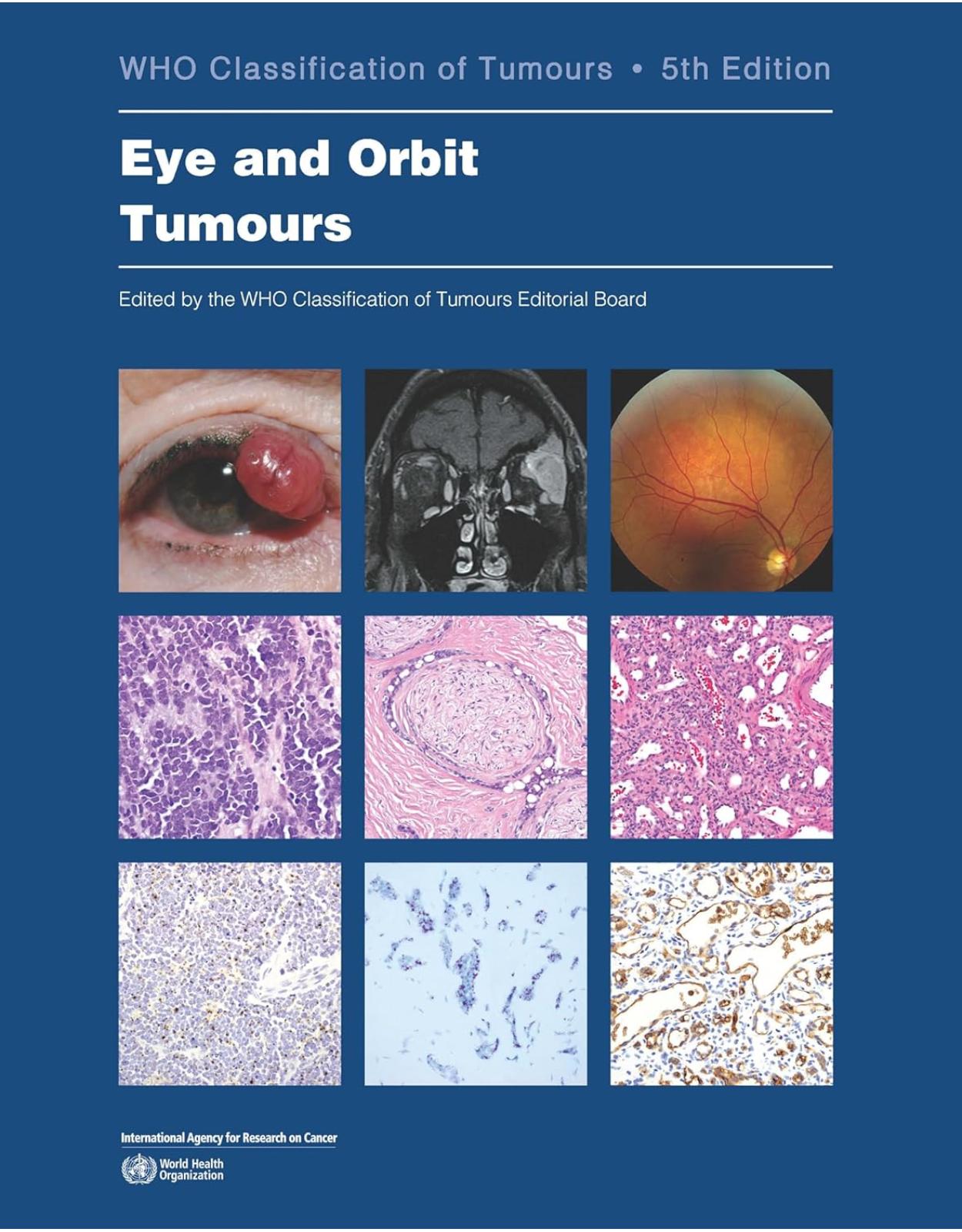 The WHO Classification of Tumours. WHO Classification of Eye and Orbit Tumours, 5th edition