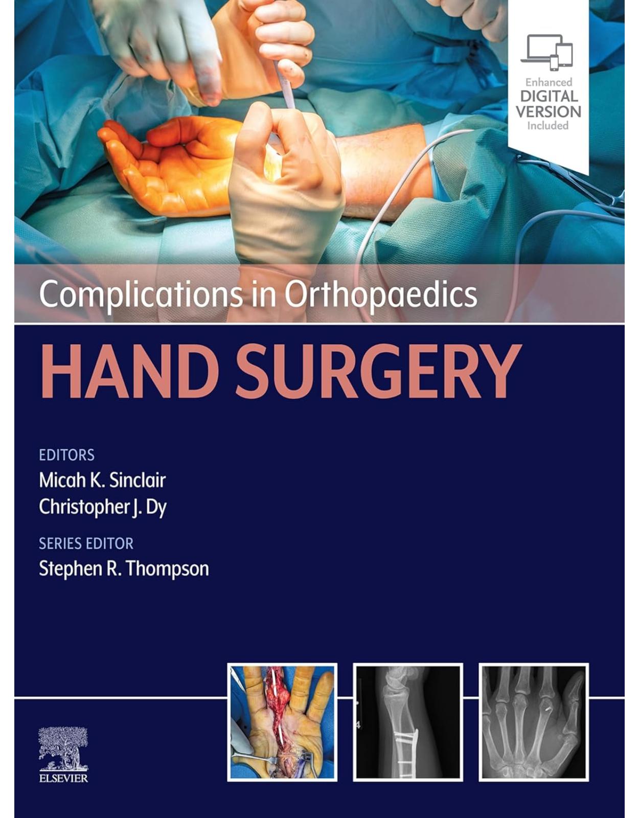 Complications in Orthopaedics: Hand Surgery
