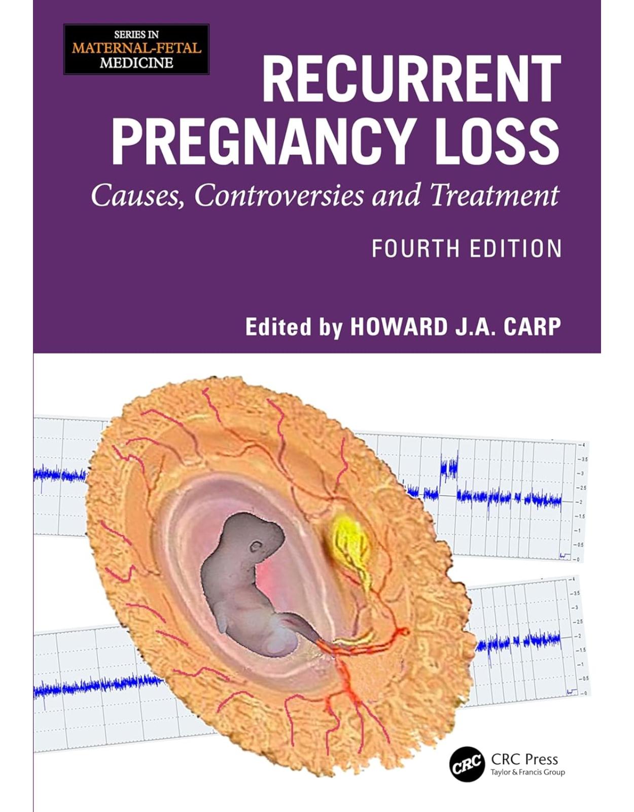 Recurrent Pregnancy Loss Causes, Controversies and Treatment