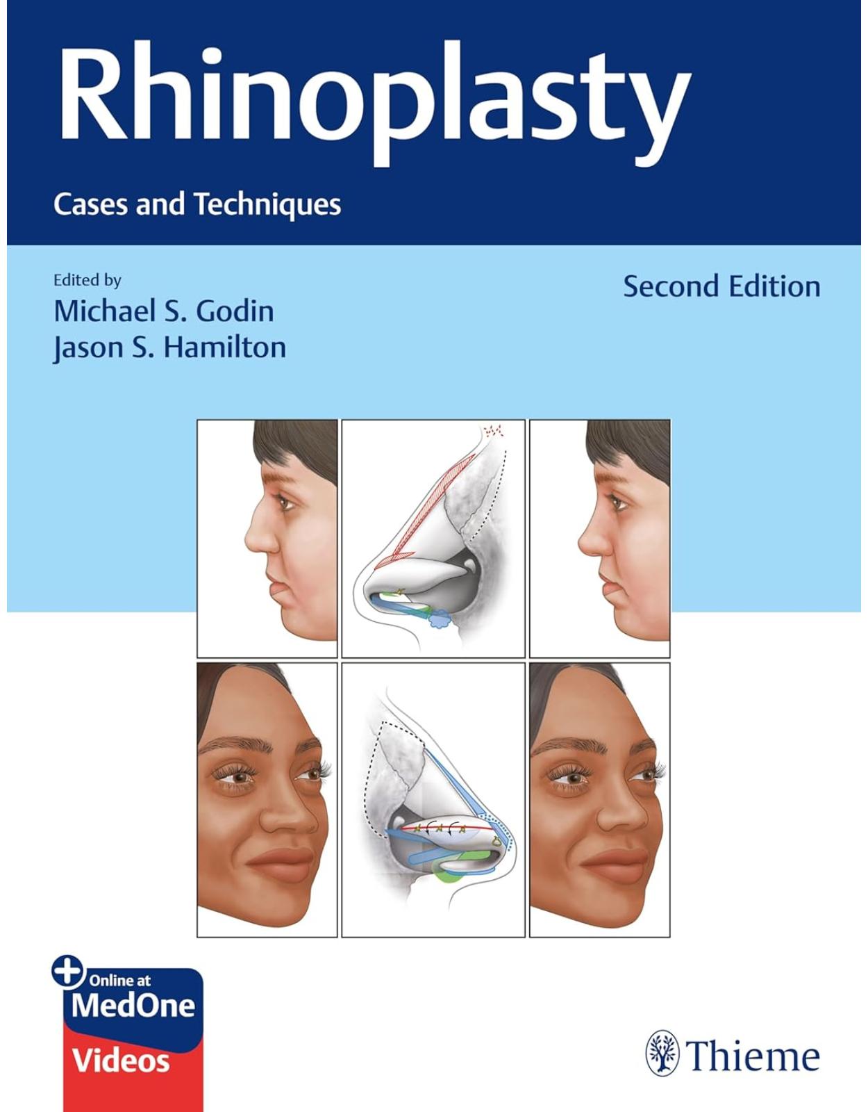 Rhinoplasty. Cases and Techniques