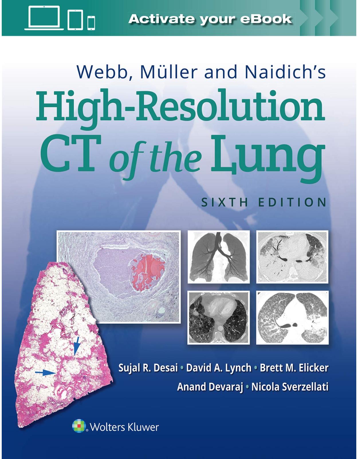 Webb, Müller and Naidich’s High-Resolution CT of the Lung 